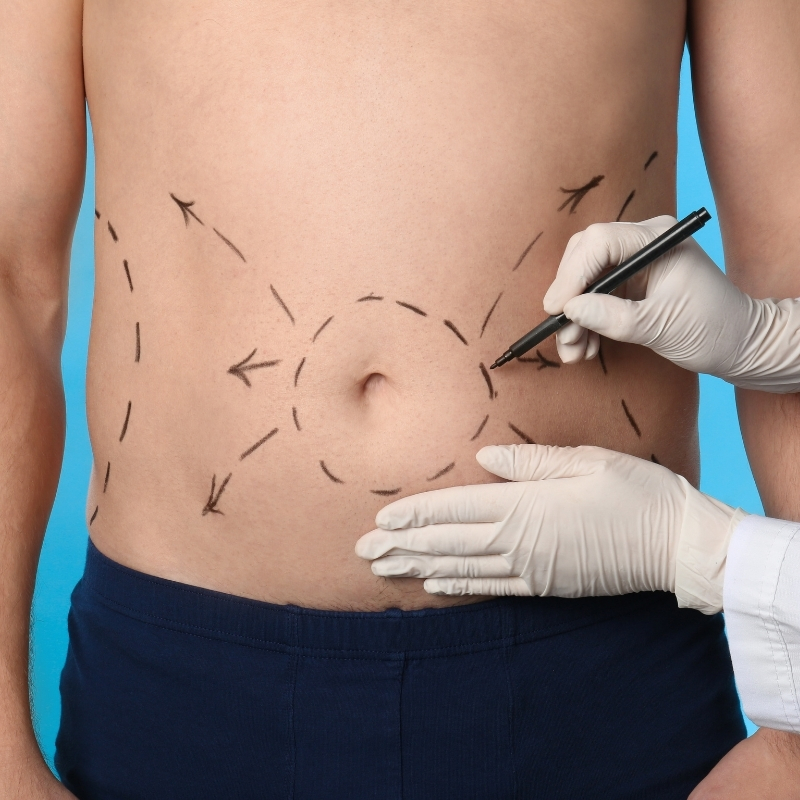 Resultado Abdominoplastia