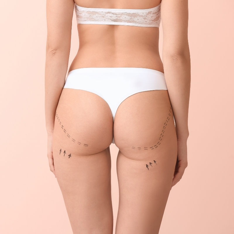Resultado Gluteoplastia